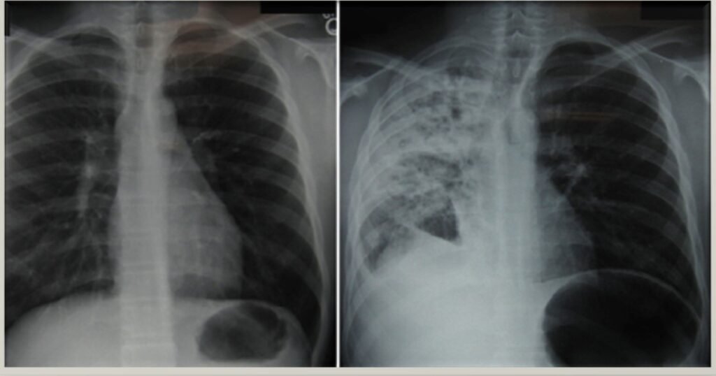 what are the signs and symptoms of tb